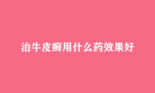 治牛皮癣用什么药效果好
