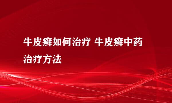 牛皮癣如何治疗 牛皮癣中药治疗方法