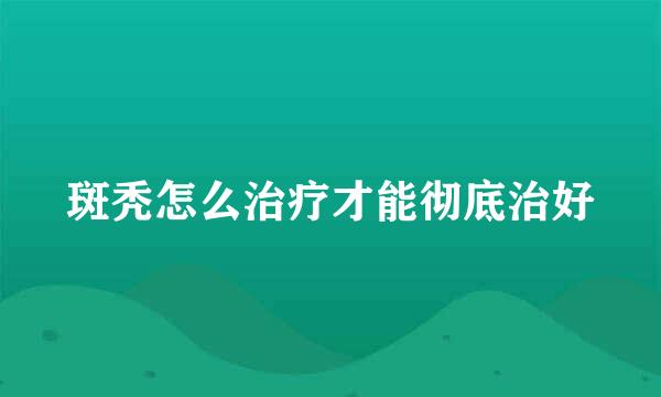 斑秃怎么治疗才能彻底治好