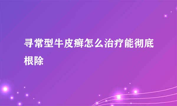 寻常型牛皮癣怎么治疗能彻底根除